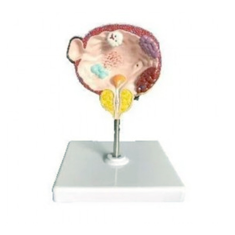 Diseased Bladder and Prostate Model