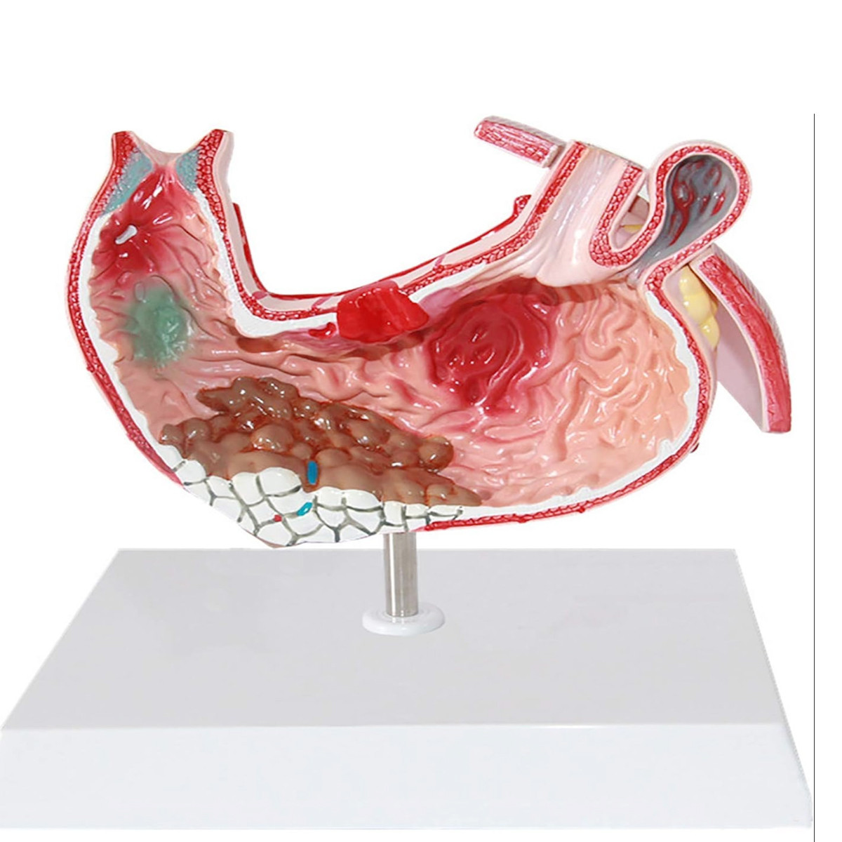 Diseased Stomach Model